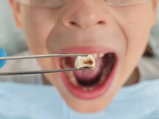 Best Emergency Dental Filling Replacement  in Vanceburg, KY